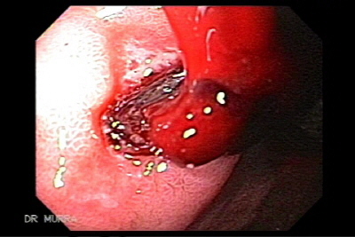 Ulcera del Duodeno con sangrado activo de la cual emerge un coágulo de sangre.