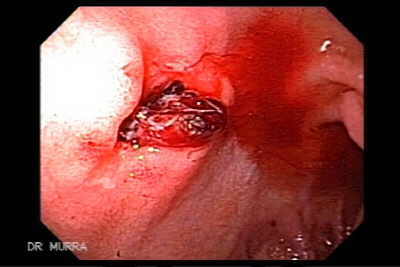 Hemorragia por úlcera duodenal.