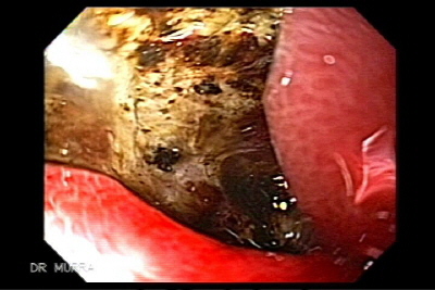 Sangrado del Tubo digestivo por Ulcera Gigante del Duodeno