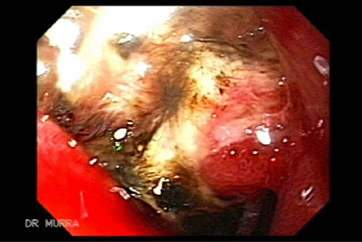 Ulcera Duodenal Gigante