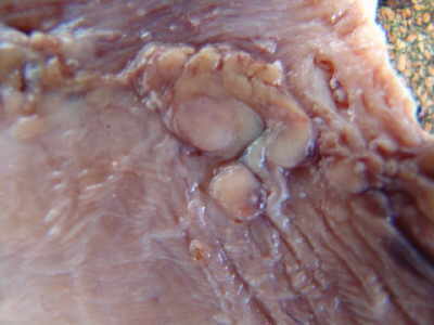 Pieza Quirúrgica Gastrectomía Completa, cáncer gástrico, etapa temprana.
