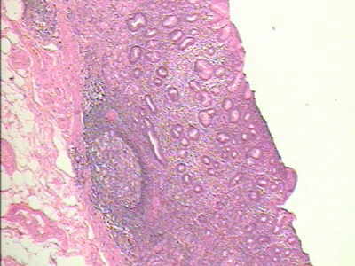 Histopatología de Cáncer Gástrico etapa incipiente