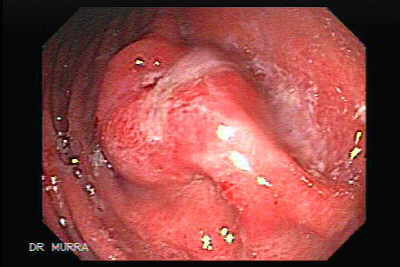 Endoscopia de Adenocarcinoma Gástrico en Etapa Temprana.