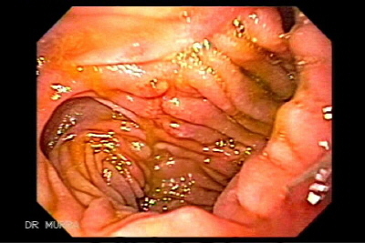Fistula Enterocutánea
