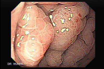 Gastritis Eosinofílica
