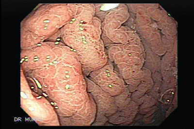 Gastritis Eosinofílica.