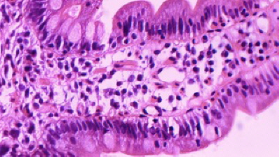 Duodenitis Eosinofilica