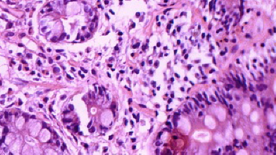 Duodenitis Eosinofilica