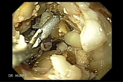 Obstrucción esofago