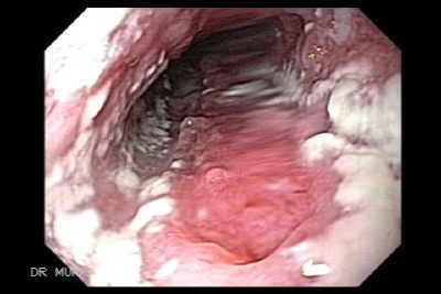Imagen endoscópica y video de Histoplasmosis del esófago
