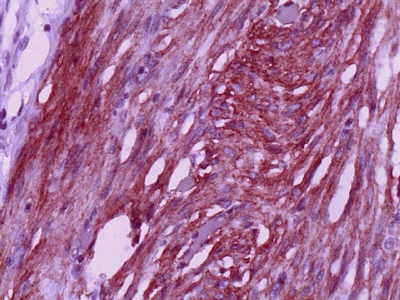 Tumor Estromal Gastrointestinal (GIST)