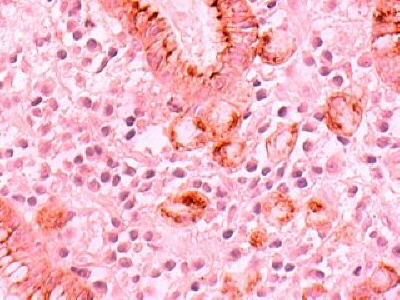 Cancer Células en Anillo de sello 