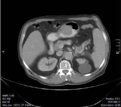 Tumor del Estroma Gastrointestinal (GIST)