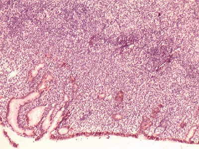 Citoqueratina evidenciando las diferencias de la parte epitelial y linfoide.