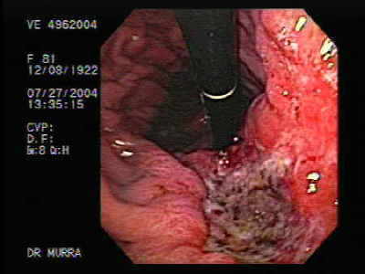 Extenso Adenocarcinoma Ulcerado del Cuerpo Gástrico.
