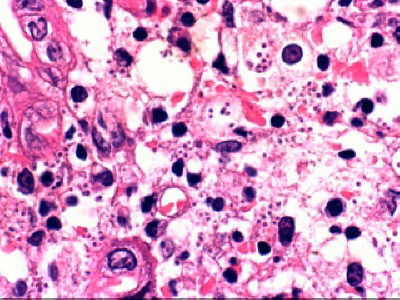 Histoplasmosis Gastroduodenal