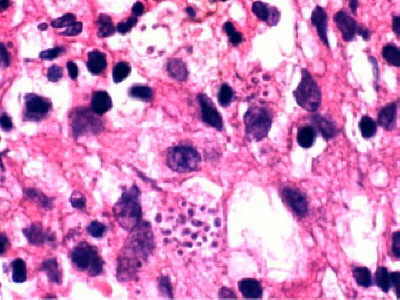 Histoplasmosis Gastroduodenal