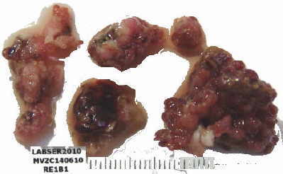 Pólipo gigante del colon
