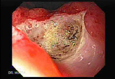 Ulcera Gastrica.