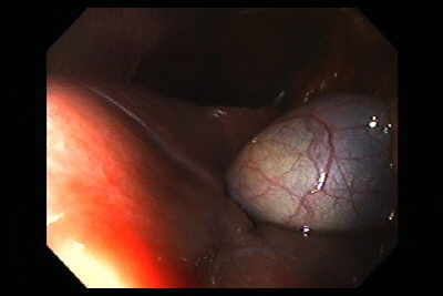 Laparoscopia de Tumor Estromal Gastrointestinal (GIST)
