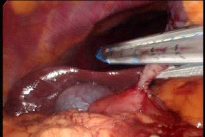 Laparoscopia de Tumor Estromal Gastrointestinal (GIST)