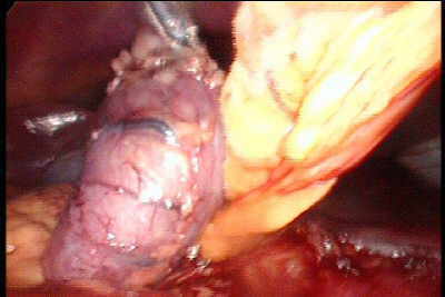 Laparoscopia de Tumor Estromal Gastrointestinal (GIST) 
