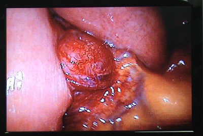 Tumor Estromal Gastrointestinal (GIST)
