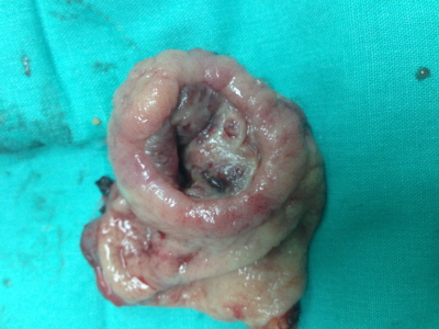 Espécimen quirúrgico de Tumor Estromal Gastrointestinal (GIST)