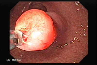 Pancreas Heterotopico