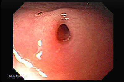 Pancreas Heterotopico