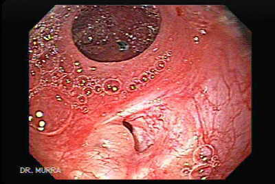 Anastomosis urétero-ileal