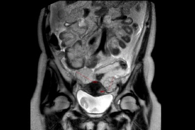 Linitis Plástica con Tumor de Krukenberg Bilateral