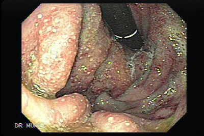 Siembras de Metástasis de Carcinoma de Ovario a
