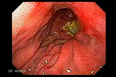 Neoplasia Gastrica