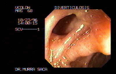 Melanosis Coli y Divertículos.