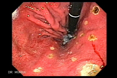 Ulcera Gastrica.