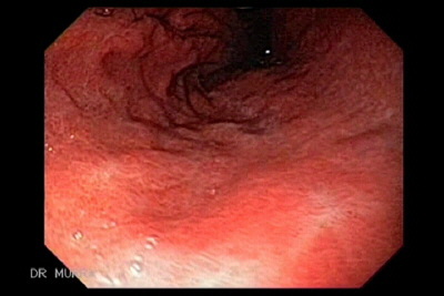 Ulcera Gastrica