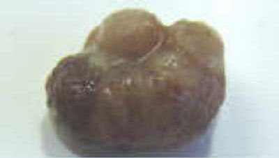 Se aprecia neoplasia polipoide con superficie lobulada