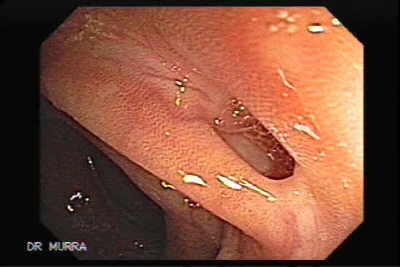 Imagen Endoscópica de Melanosis Coli y Divertículos