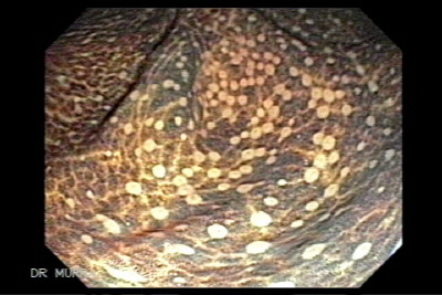 Imagen y Video de Melanosis Coli