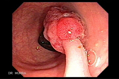Pólipo ulcerado sincrónico del colon descendente, al cual se le practicó polipectomía.