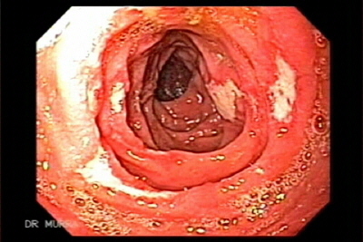Ulcera Duodeno