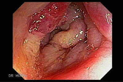 Cistoadenocarcinoma musinoso de ovarios que infiltra el recto.