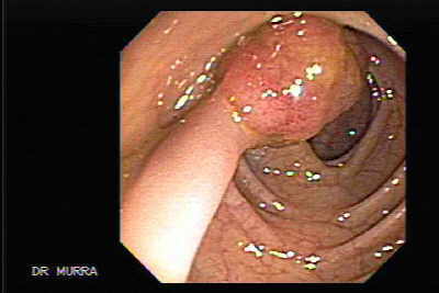 Polipectomía de Pólipo Pediculado