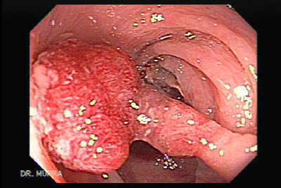 pólipo colon