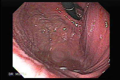 Dilatacion esofagica
