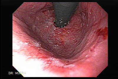 Dilaatcion del esofago