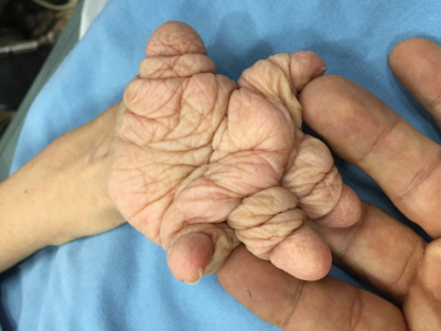 Síndrome de Plummer-Vinson y Artritis Reumatoide mutilante