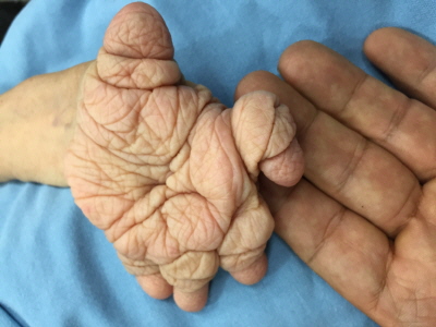 Sindrome de Plummer Vinson y Artritis Reumatoide Mutilante