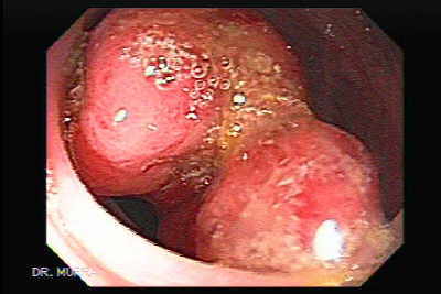 Polipectomía Endoscópica de masa grande pediculada